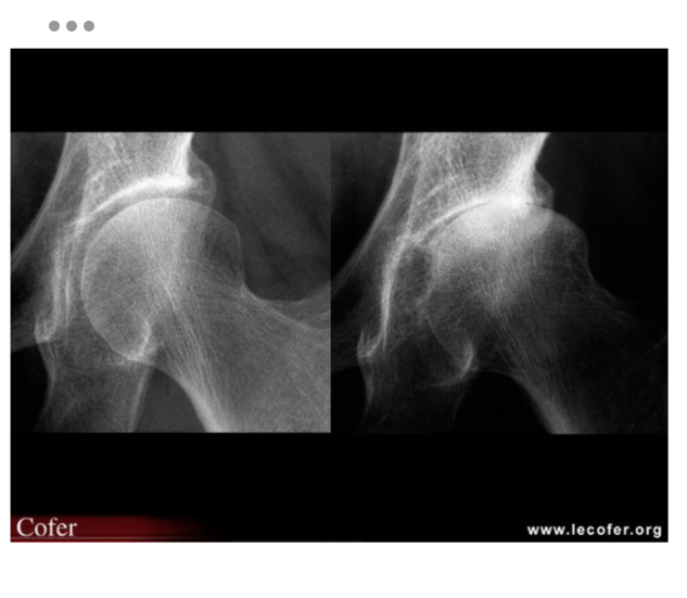 <ul><li><p>pincement supéro-externe de l’interligne coxo-fémorale </p></li></ul><p></p>