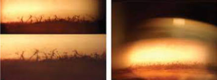 <p>what is the finding shown in this image? </p>