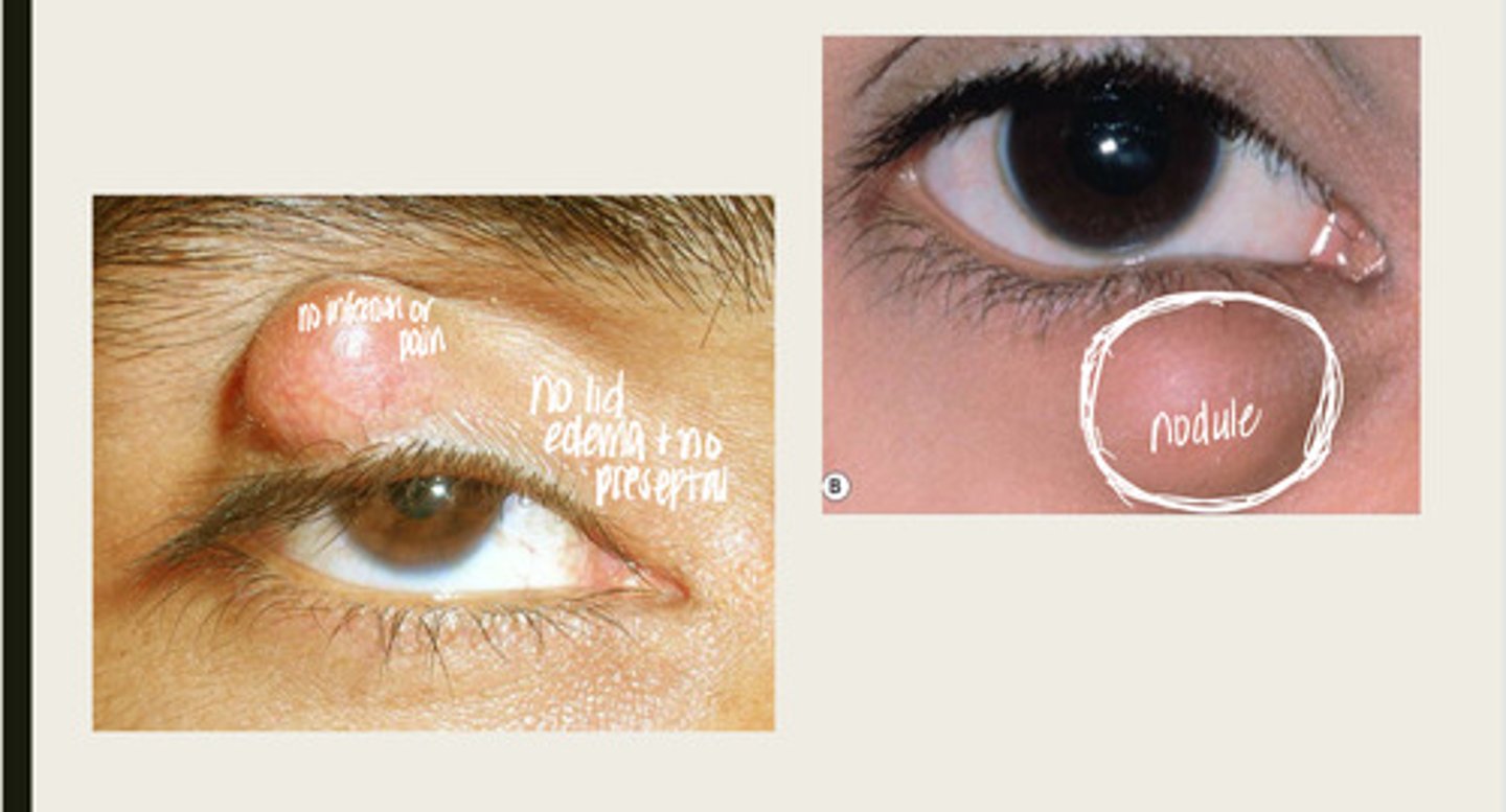 <p>Is a chalazion an active infection?</p>