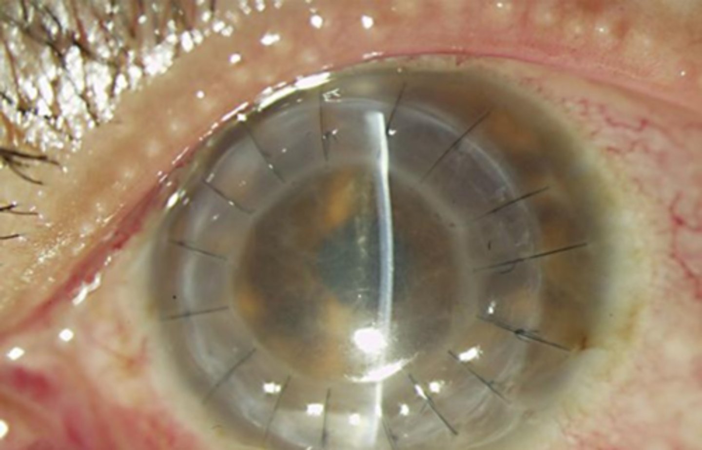 <p>What some important post-op pt limitations we need to educate on?</p>