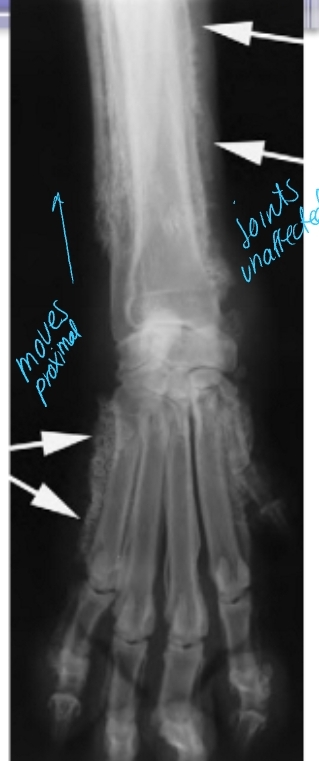 <p><span style="background-color: transparent;"><strong><span>Hypertrophic Osteopathy (HO)</span></strong></span></p>