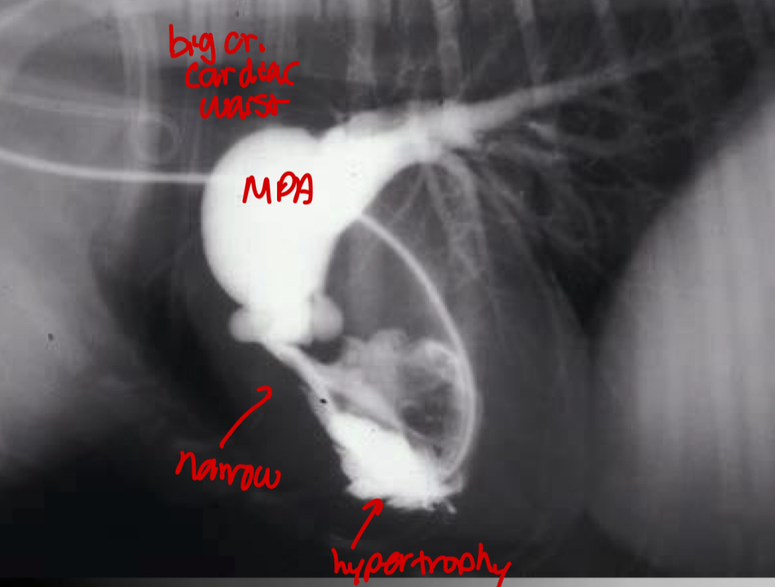 <p>-RV hypertrophy</p><p>-narrowing pulmonary outflow tract</p><p>-post-stenotic dilation of MPA segment</p>