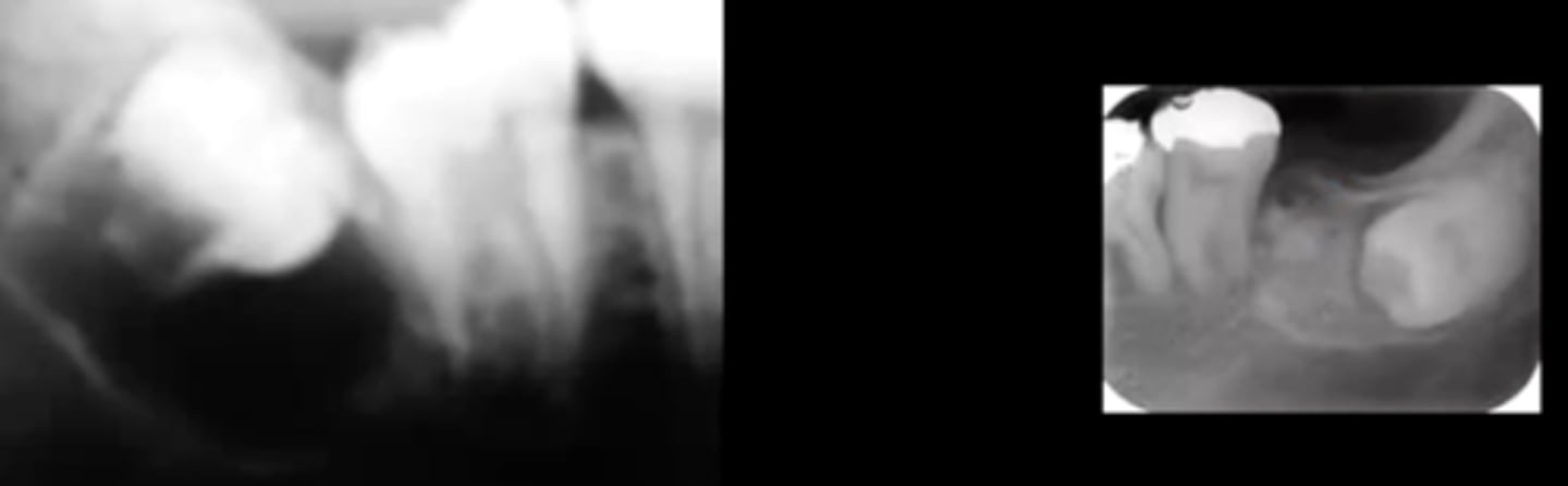 <p>they are fibrous tumors with benign bone in it</p><p>radiographically present as either a RL or RO circumscribed lesion</p>