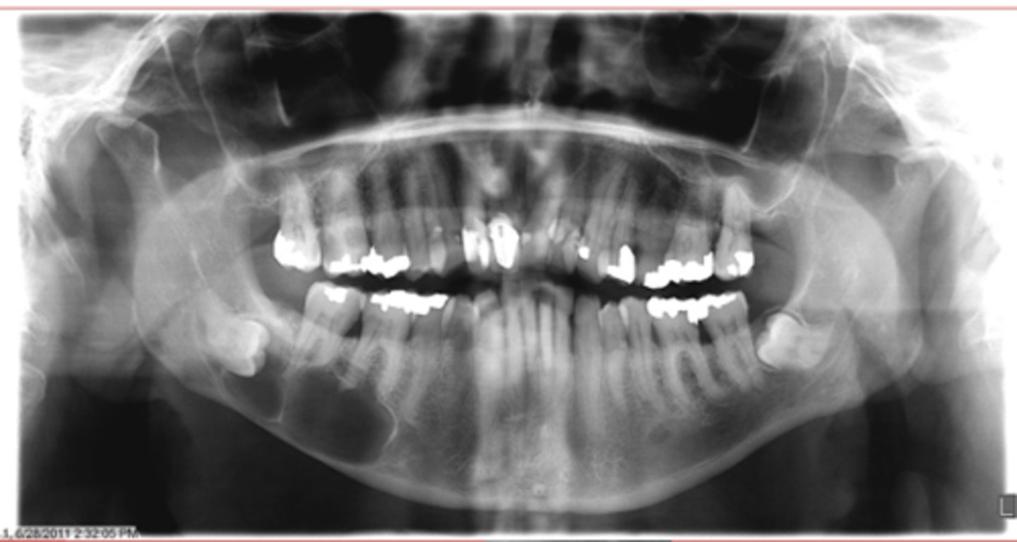 <p>DDX (differential diagnosis) for the cyst:</p>