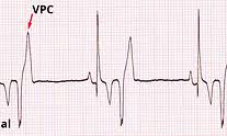 <p>Bizarre QRS &gt;3 consecutive beats not preceded by P wave</p>