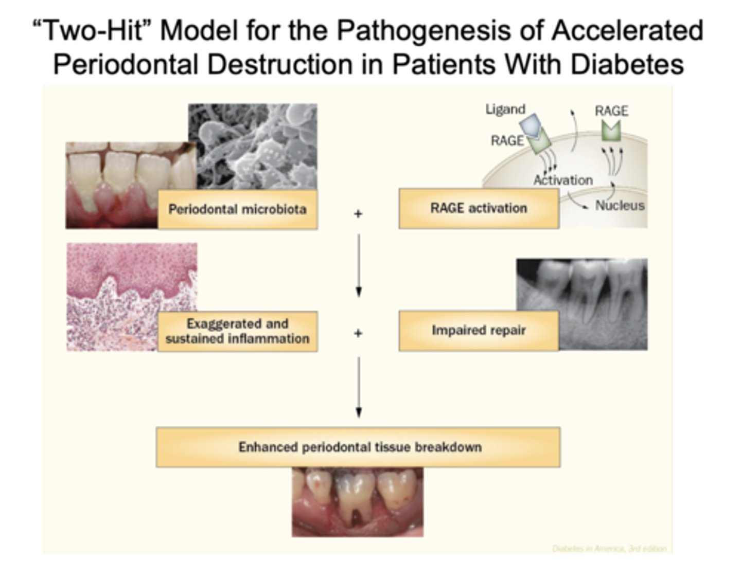 <p>Periodontal microbiota and RAGE activation resulting in exaggerated and sustained inflammation and impaired repair, resulting in enhanced periodontal tissue breakdown</p>