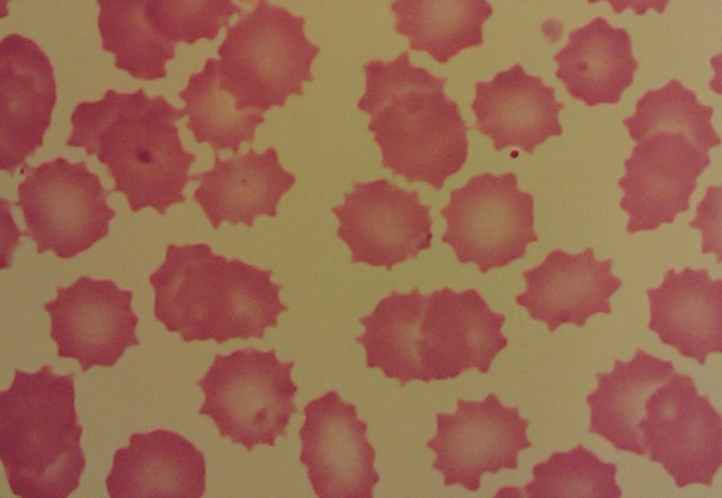 <p>-burr cell/crenated</p><p>-RBC with many (20-30) small, regular, blunt projections</p><p>(cell shape)</p>