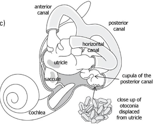 <p><strong><em>Benign Paroxysmal Positional Vertigo</em></strong></p><ul><li><p><u>Benign</u> = harmless in the long-term</p></li><li><p><u>Paroxysmal</u> = Sudden onset/recurrence of symptoms (<60sec)</p></li><li><p><u>Vertigo</u> = Sensation of spinning/dizziness</p><ul><li><p><strong><u>Vertigo itself is a symptom (not an illness)</u></strong></p></li></ul></li></ul><p>Caused by:</p><ul><li><p>Ear stones (otoconia) migrating into semi-circular canals</p></li><li><p>Disrupting the cupula located in ampulla</p></li></ul><p>Treatment:</p><ul><li><p>Often resolves on own, but...</p></li><li><p>Specific head manoeuvres can reposition debris out</p></li></ul><p></p>