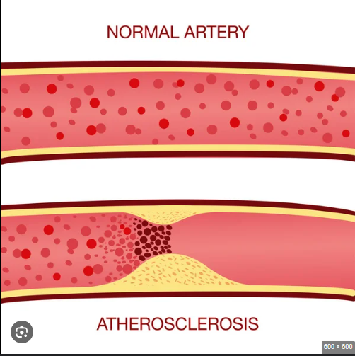 <p>When fat cholesterol builds up, the fat dries up and turns into plaque, leading to atherosclerosis, leading to an increase in blood pressure as the heart tries to pump the blood through, possibly leading to a heart attack </p>