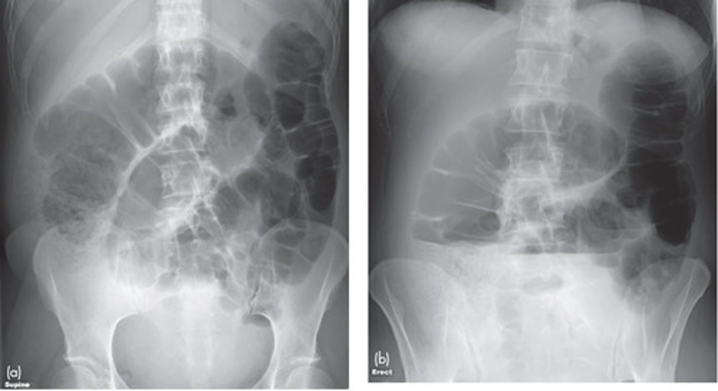 <p>lesion obstructs lumen of the large bowel, proximal to transition point large bowel dilates, distal to transition point peristalsis continues, emptying colon</p><p>Causes: tumor, hernia, volvulus, diverticulitis, intussusception</p>