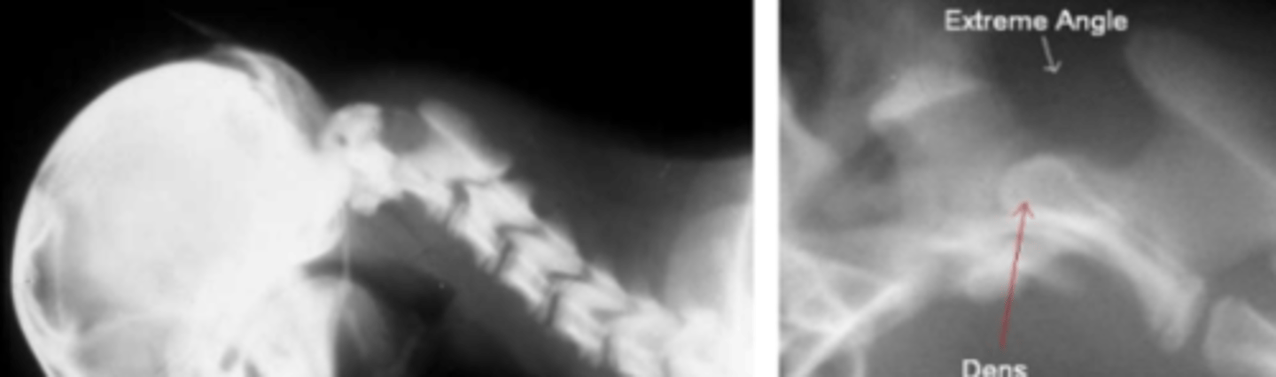 <p>- Low head carriage</p><p>- Tetra paresis and tetra ataxia in all four legs</p><p>- Inability to stand or move the legs</p><p>- Difficulty breathing</p>