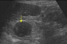 <p>What is the pathology seen here?</p>