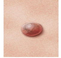 <p>Elevated solid palpable mass circumsized border</p><p>&lt; than 0,5cm</p><p>moles</p>