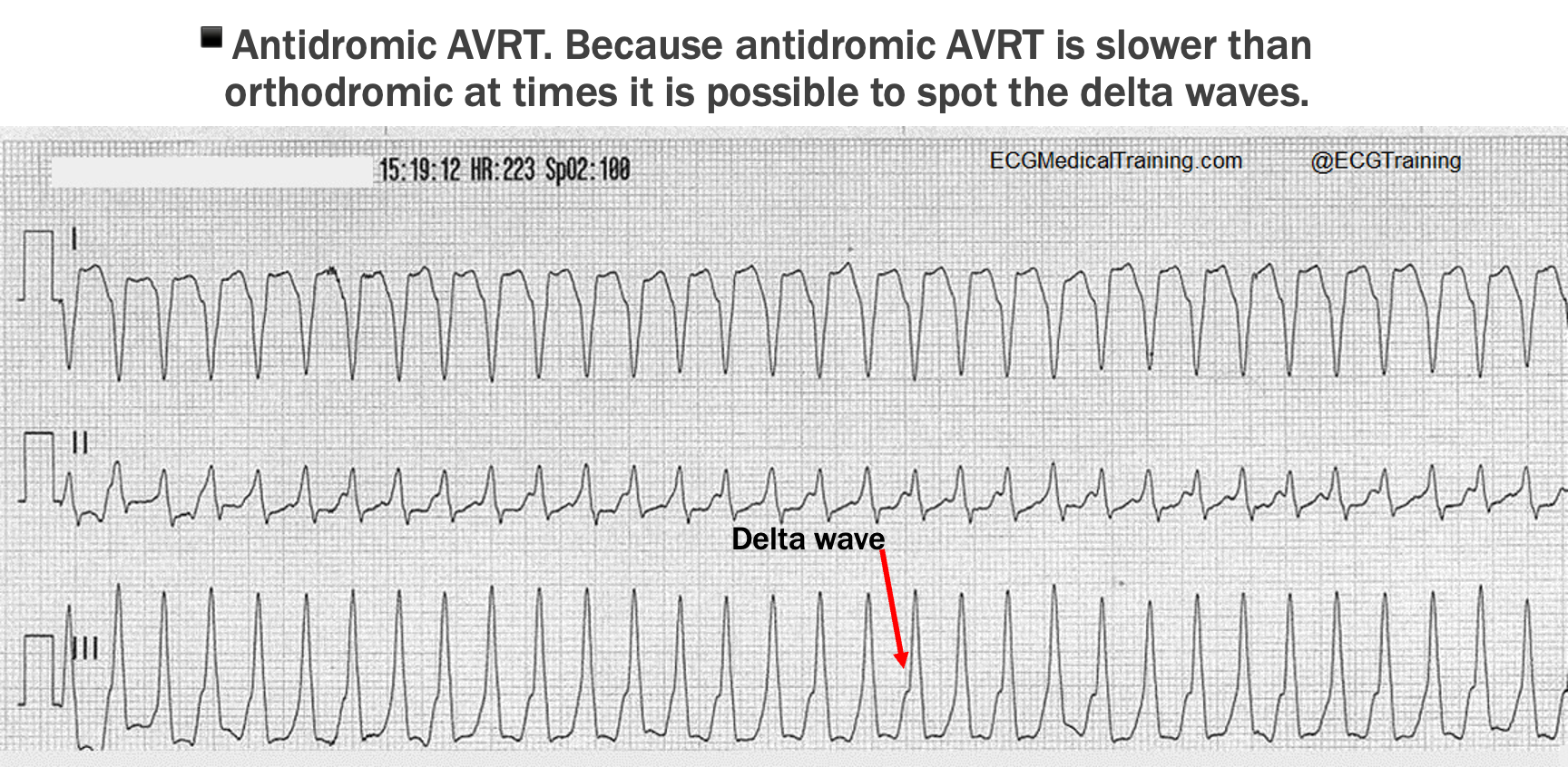 <p>conduction occurs down accessory pathway and up normal pathway, retrograde (towards atria)</p><p>produces regular, monomorphic and wide tachycardia</p>
