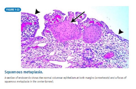 <p>bronchus is normally comprised of columnar epithelium</p><p>new stressor: chronic irritation from long-term tobacco use causes metaplasia</p><p>new tissue: squamous epithelium</p>