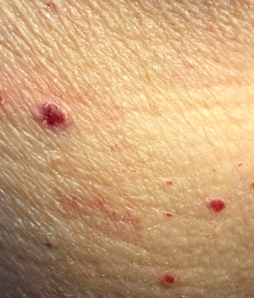 <p>Papule</p>