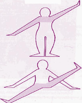 <p>What bilateral pattern is shown on the picture?</p>