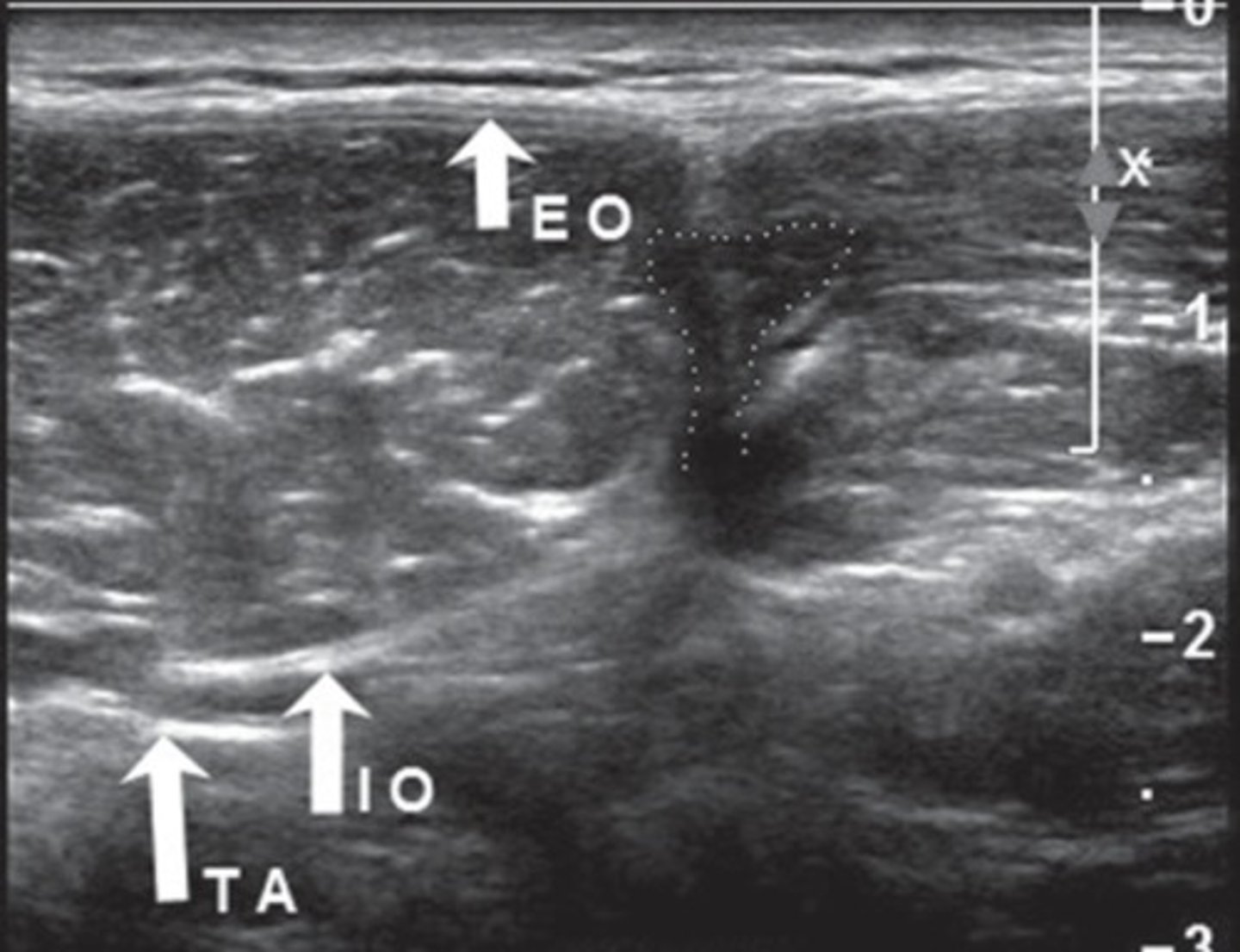 <p>Along Spigelian fascia</p>