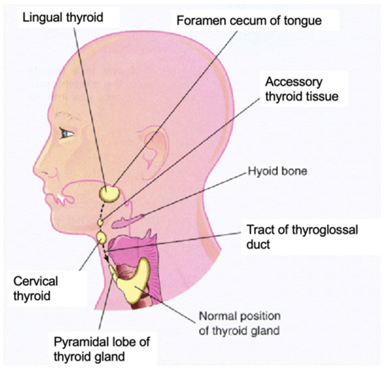 <p>What is the term for a thyroid gland that develops in an abnormal location?</p>
