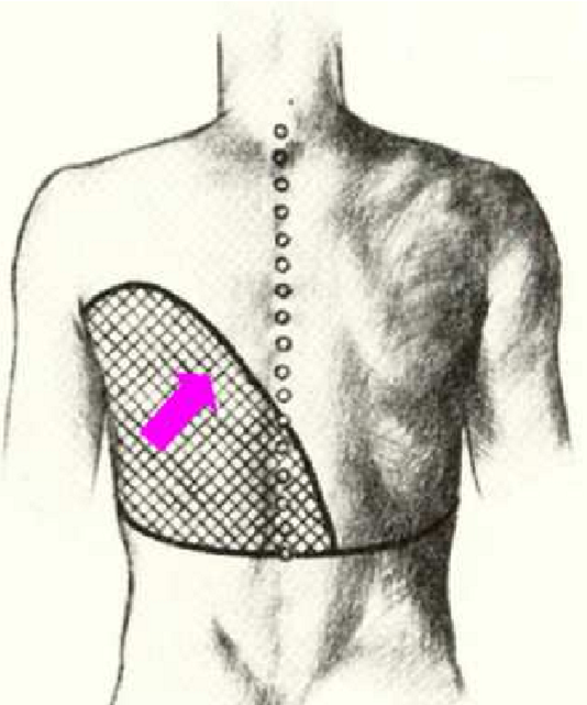 <p>curved upper border of a pleural effusion</p><ul><li><p>concave upward</p></li><li><p>homogeneous opacity</p></li></ul><p></p>
