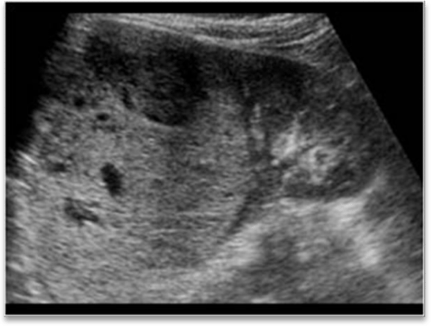 <p>-hypoechoic to moderately echogenic</p><p>-large bulky tumor</p><p>-may spread beyond capsule</p>