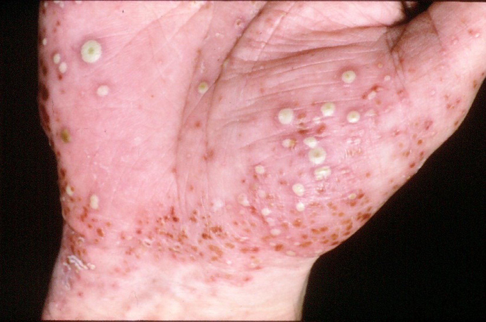 <p>PP: psoriasis+pustules</p><p>E: tobacco</p><p>CM:<br>sterile+red+scaly pustules<br>-palms<br>-soles<br>-nails</p><p>DX: “oil-drop” sign</p><p>TX:<br><u>topical:</u><br><strong>1st line→topical steroids</strong><br>topical calcipotriene<br>anthralin+coal tar<br>narrow band UV x 3x/week</p><p><u>systemic:</u><br>methotrexate<br>acute→cyclosporine+taper off<br>PO acitretin<br>apremilast</p><p><u>Biologics:</u><br><strong>TNF alpha inhibitors:</strong><br>-entanercept<br>-adalimumab</p><p><strong>interleukin 12+23 inhibitor:</strong><br>-ustekinumab</p><p><strong>interleukin 17 inhibitors:</strong><br>-ixekizumab<br>-secukinumab</p><p><strong>interleukin 23 inhibitor:</strong><br>-guselkumab<br>-risankizumab<br>-tildrakizumab</p>