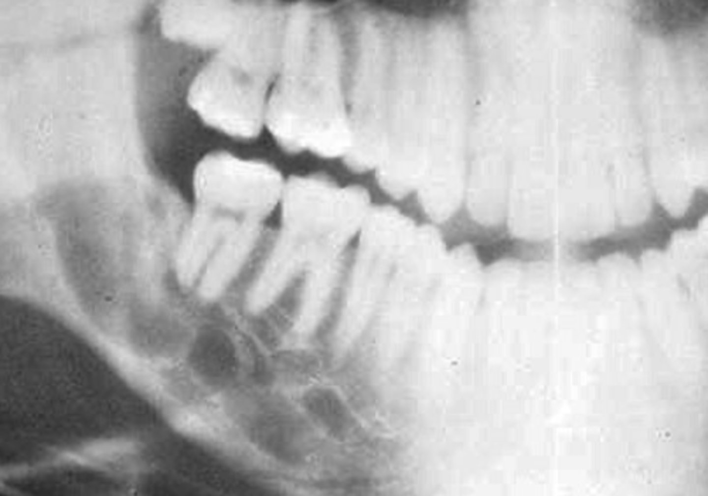 <p>- Honeycomb (multilocular) appearace</p><p>If unilocular, use a stethescope nd listen for pulse - if it has pulse, leave alone bc may be AV malformation</p>