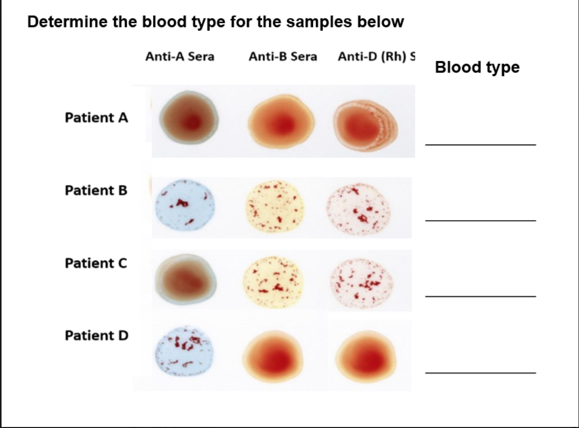 <p>Patient A </p><ul><li><p>Anti-A: <strong>No clumping</strong> → No A antigen</p></li><li><p>Anti-B: <strong>No clumping</strong> → No B antigen</p></li><li><p>Anti-D: <strong>Clumping</strong> → Rh present<br><span data-name="check_mark_button" data-type="emoji">✅</span> <strong>Blood type = O+</strong></p></li></ul><p>  Patient B </p><ul><li><p>Anti-A: <strong>Clumping</strong> → A antigen present</p></li><li><p>Anti-B: <strong>No clumping</strong> → No B antigen</p></li><li><p>Anti-D: <strong>Clumping</strong> → Rh present<br><span data-name="check_mark_button" data-type="emoji">✅</span> <strong>Blood type = A+</strong></p></li></ul><p>  Patient C </p><ul><li><p>Anti-A: <strong>Clumping</strong> → A antigen present</p></li><li><p>Anti-B: <strong>Clumping</strong> → B antigen present</p></li><li><p>Anti-D: <strong>Clumping</strong> → Rh present<br><span data-name="check_mark_button" data-type="emoji">✅</span> <strong>Blood type = AB+</strong></p></li></ul><p>  Patient D </p><ul><li><p>Anti-A: <strong>Clumping</strong> → A antigen present</p></li><li><p>Anti-B: <strong>No clumping</strong> → No B antigen</p></li><li><p>Anti-D: <strong>No clumping</strong> → No Rh<br><span data-name="check_mark_button" data-type="emoji">✅</span> <strong>Blood type = A-</strong></p></li></ul><p></p>