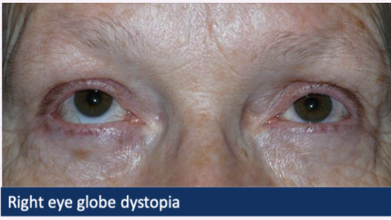 <ul><li><p><strong>Globe dystopia</strong></p></li></ul><p>- Proptosis/exopathlmus → bulging eye</p><p></p><ul><li><p>Hyperglobus → eye directed upwards</p></li><li><p>Hypoglobus → eye directed downwards</p></li></ul><p></p><ul><li><p><mark data-color="blue" style="background-color: blue; color: inherit;">Restricted ocular motility</mark></p></li></ul><p></p>