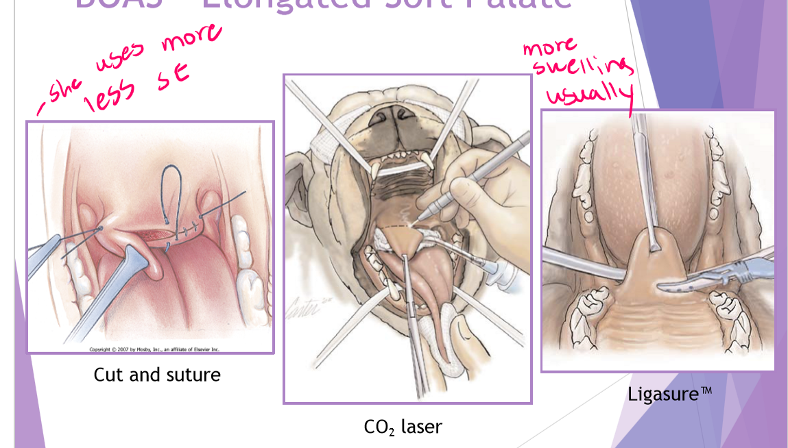 <ul><li><p>palate extends >1-3mm beyond the epiglottis </p><ul><li><p>subjective evaluation - caution </p></li><li><p>can use tonsils as a guideline </p></li></ul></li><li><p>laryngeal mucosa becomes inflamed </p></li><li><p>why a concern </p><ul><li><p>laryngeal edema = airway obstruction </p></li><li><p>chronic upper airway stress </p></li><li><p>like having curtains over open window decreased airflow the soft palate drops down over the epiglottis </p></li></ul></li><li><p>surgical technique (staphylectomy/palatoplasty) - shortening the soft palate </p><ul><li><p>remove elongated portion of the palate </p></li><li><p>trim to level of tonsils / just past tip of epiglottis </p></li></ul></li><li><p>complications </p><ul><li><p>laryngeal edema </p><ul><li><p>airway obstruction </p></li><li><p>short term </p></li></ul></li><li><p>hemorrhage </p></li><li><p>aspiration </p></li></ul></li></ul><p></p>