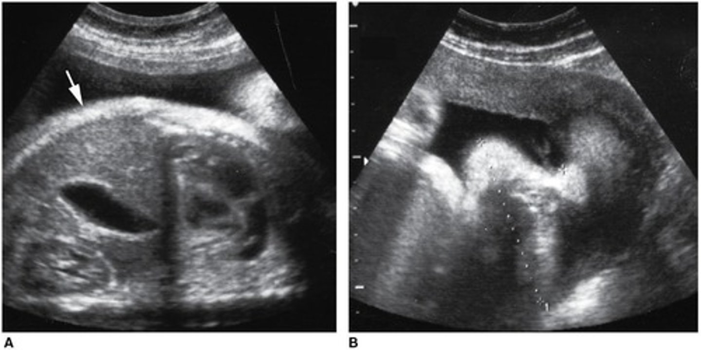 <p>- 2VC</p><p>- Anencephaly</p><p>- Club foot</p><p>- Skin thickening</p><p>- Enlarged eye orbits</p>