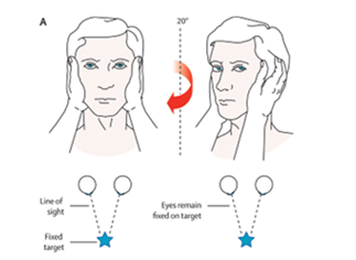 <ol><li><p>Position patient upright fixating gaze on nose whole time</p></li><li><p>Hold patients head with both hands&nbsp;</p></li><li><p>Move head slowly side to size for a baseline&nbsp;</p></li><li><p>Give a small. quick and unpredictable thrust to one side and return to midline. Repeat on other side.&nbsp;</p></li><li><p>Repeat 2-3 times on each side</p></li></ol><ul><li><p><u>Positive test: </u>unable to maintain fixation</p></li></ul><p></p><ul><li><p>differentiate <strong>peripheral vs central vertigo</strong> and <strong>VOR</strong></p></li><li><p><strong>“Saccade = Side of lesion”</strong></p></li></ul><p><u>Abnormal finding:</u> Patients eyes move with their head and then make a corrective saccade back to nose</p><table style="min-width: 50px;"><colgroup><col style="min-width: 25px;"><col style="min-width: 25px;"></colgroup><tbody><tr><th colspan="1" rowspan="1"><p>Result</p></th><th colspan="1" rowspan="1"><p>Suggests</p></th></tr><tr><td colspan="1" rowspan="1"><p><strong>Abnormal HIT</strong> (with corrective saccade)</p></td><td colspan="1" rowspan="1"><p><strong>Peripheral</strong> cause (e.g., vestibular neuritis)</p></td></tr><tr><td colspan="1" rowspan="1"><p><strong>Normal HIT</strong> (no corrective saccade, despite vertigo)</p></td><td colspan="1" rowspan="1"><p><strong>Central</strong> cause (e.g., stroke)</p></td></tr></tbody></table><p></p>