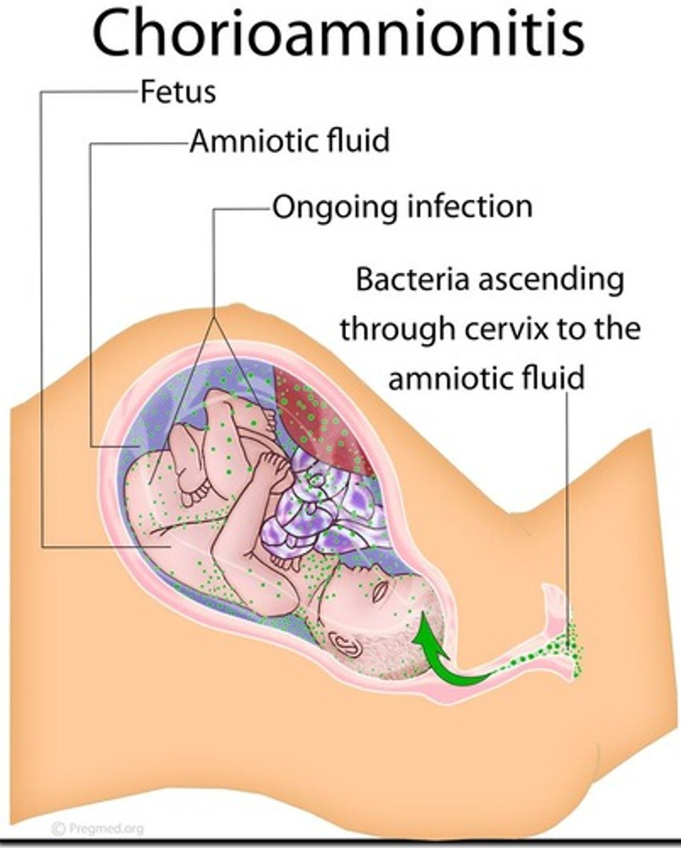 <p>A bacterial infection of the amniotic cavity, a major cause of complications for mothers and newborns.</p>