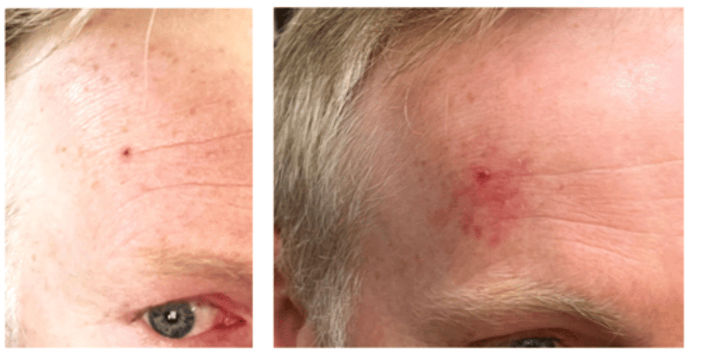 <p>complete excision with Mohs procedure for deep lesions to prevent recurrence and ensure best prognosis</p><p>radiation if poor surgical candidates, superficial lesions</p><p>chemotherapy with imiquimod, 5-FU for superficial lesions</p><p>PDT for superficial lesions</p>