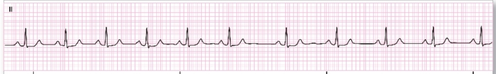 <ul><li><p>Slight variation of a sinus rhythm</p></li><li><p class="has-focus">Bainbridge reflex- sudden changes in pressure</p></li><li><p class="has-focus">Increases SV and blood pressure</p></li><li><p class="has-focus">Normal finding in children and young adults</p></li></ul><p></p>