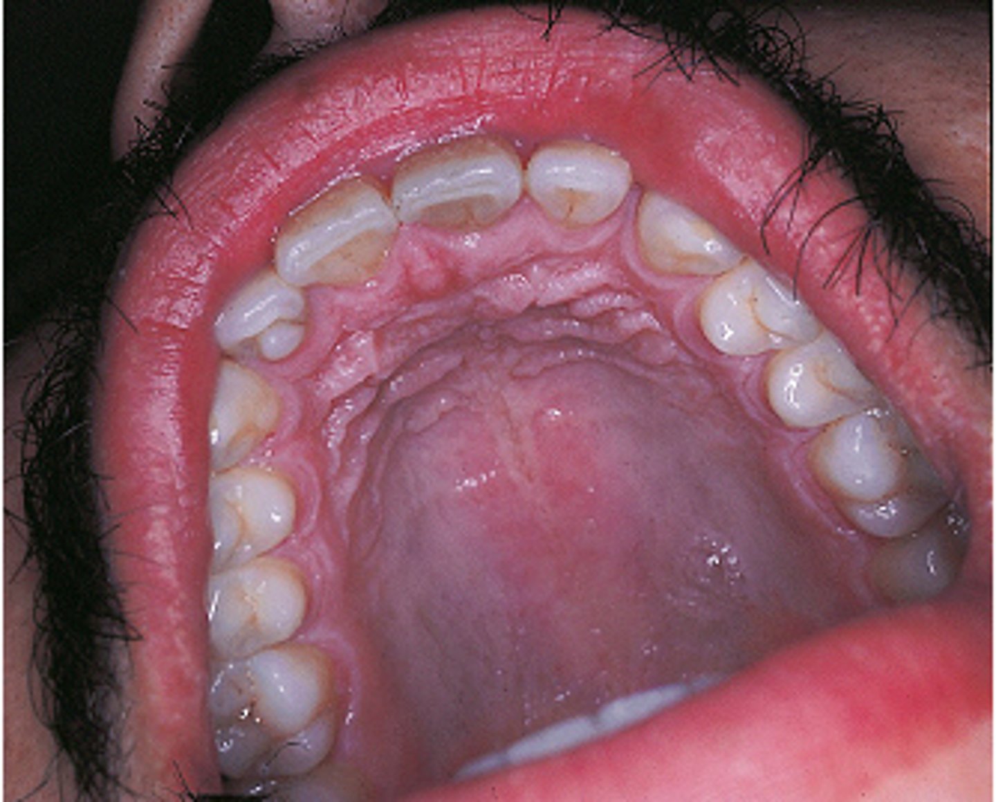 <p>talon cusp.</p><p>A talon cusp is an accessory cusp located in the cingulum of a maxillary or mandibular permanent incisor. A dens in dente is a developmental anomaly that results when the enamel organ invaginates into the crown of a tooth before mineralization. Taurodontism is a term used to describe a developmental dental anomaly in which the teeth exhibit elongated, large pulp chambers and short roots. Dens evaginatus is an accessory enamel cusp found on the occlusal tooth surface.</p>