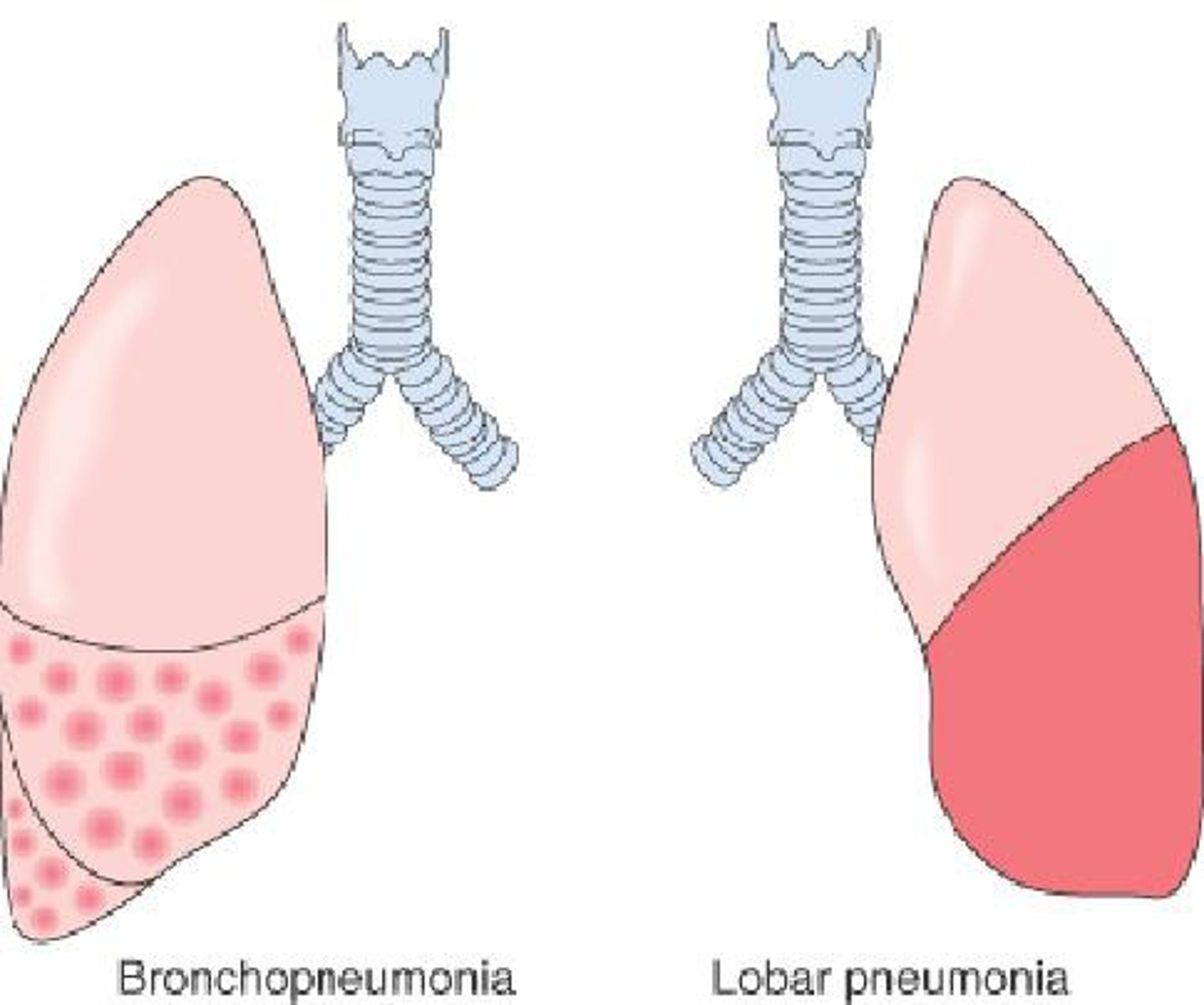 <p>infection of one or more lobes of the lung causing alveoli to fill with fluid, bacteria, blood, pus (consolidation) </p><p></p><p>◦ Health history: fever, cough w/ chest pain, blood-tinged sputum, chills, SOB, fatigue</p><p></p><p>signs:</p><p>- increased RR (24 bpm) and HR (&gt; 100 bpm)</p><p>- guarding and lag upon expansion on affected side</p><p>- chest expansion decreased on affected side</p><p>- tactile fremitus increased if bronchus patent/decreased if bronchus obstructed</p><p>- percussion dull over pneumonia</p><p>- bronchial, late inspiratory crackles over involved area</p>