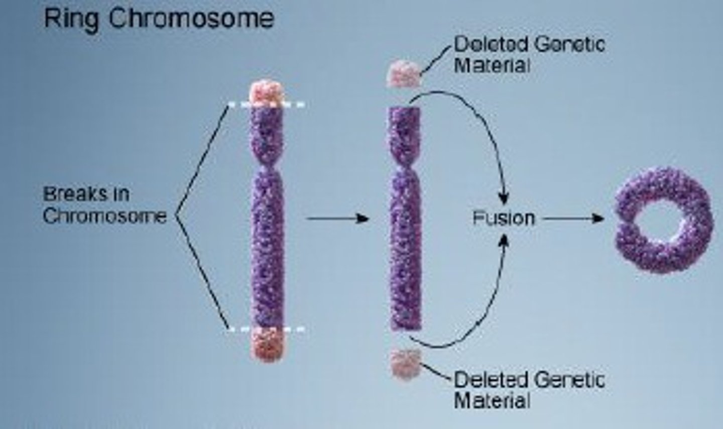 <p>when telomeres break, becoming sticky and the chromosome connects at each ends with each other. Can cause symptoms</p>