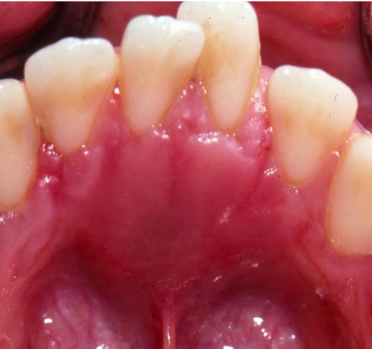 <p>asymptomatic swelling</p>