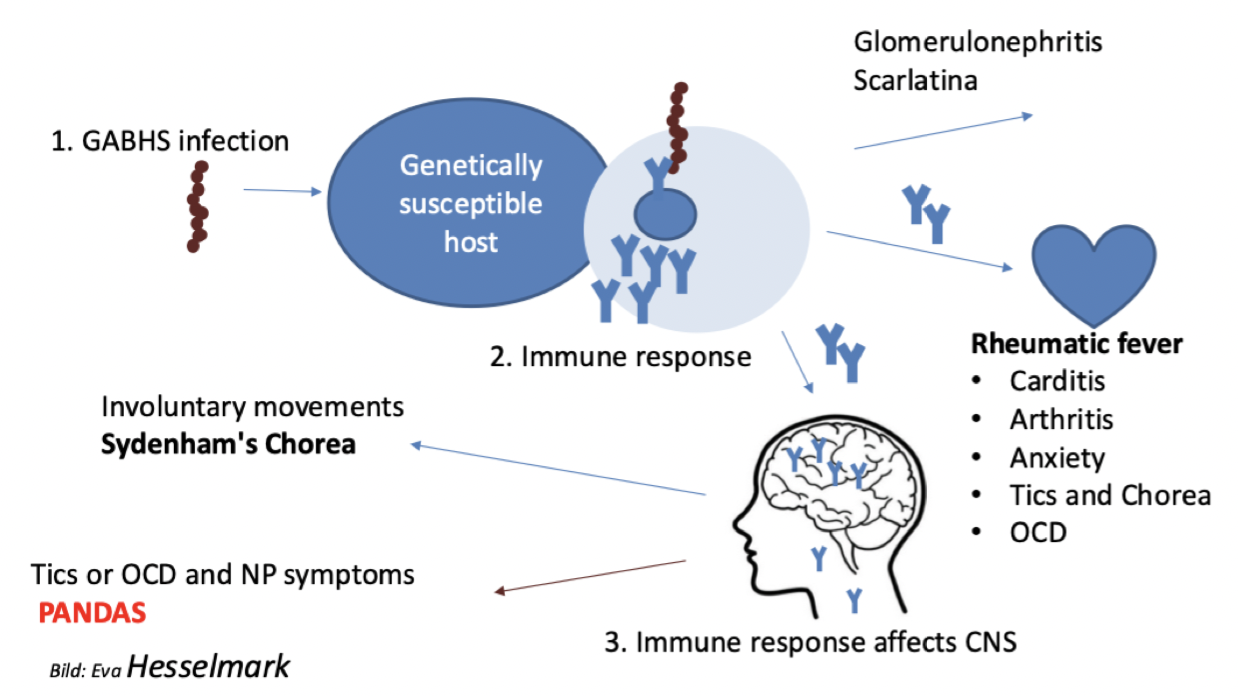 <p>PANDAS står för <strong>pediatric autoimmune neuropsychiatric disorders associated with streptococcal infections</strong>. Det är ett syndrom där barn får en akut debut av OCD och/eller tics efter infektion med grupp av betahemolyserande streptokocker. Diagnoskriterier är följande;</p><ul><li><p>OCD eller tics enligt DMS-V</p></li><li><p>Prepubertal debut</p></li><li><p>Akut/dramatisk symtomdebut</p></li><li><p>Associerad med infektionen</p></li><li><p>Neurologiska avikelser - tex koreiforma rörelser</p></li></ul><p>→ Hypotes är att autoantikroppar korsreagerar med strukturer i basala ganglier. Behandling skulle kunna attackera exempelvis antikroppar och minska symtom. </p>