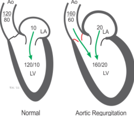 <p>Blood to back up inot the LA and pulmonary veins,w which leads to an increase in the LA pressure, and possibly leading to pulmonary congestion (due to the pressure increase).</p>