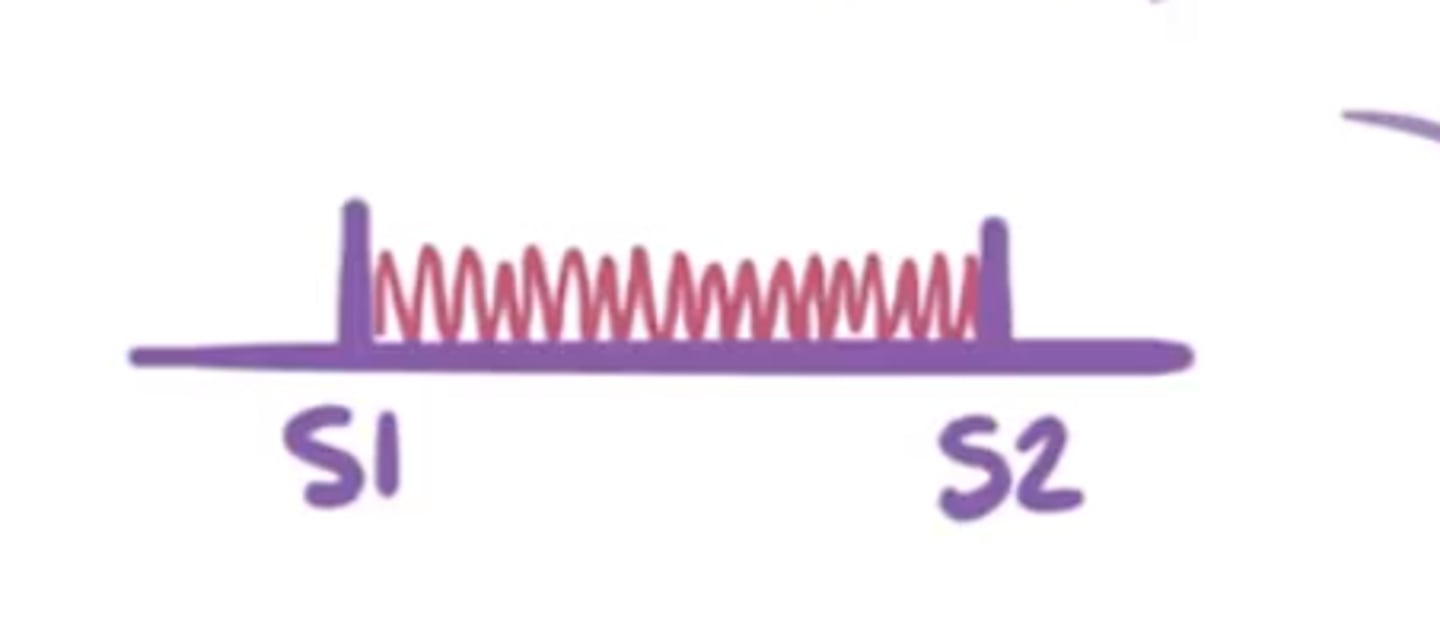 <p>- Pts. who inject drugs</p><p>- Immunocompromised</p><p>- Congenital Heart disease</p><p>- instrumentation in right heart</p>