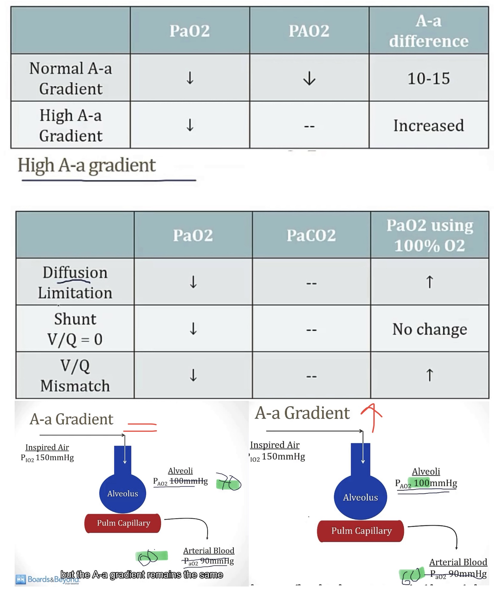 <p>-lack of O2 in the blood/defect oxygenating the blood</p><p>-A-a gradient(alveolar O2-arterial O2)</p><p>-10-15</p><p><u>Hypoxemia with a normal A-a gradient:</u></p><p>•Pa02 decreases, and PA02 also decreases(keeping A-a gradient normal)</p><p class="p1">•2 causes…</p><p class="p1">1)decreased oxygen content of air, like high altitude</p><p class="p1">2)hypoventilation</p><p class="p1">•This problem always resolves with oxygen!</p><p class="p1"></p><p class="p1"><u>Hypoxemia with an increased A-a gradient:</u></p><p class="p1">•only Pa02 decreases(causing increased A-a gradient)</p><p class="p1">•3 causes…</p><p class="p1">1)diffusion defect(consider area, wall thickness, and density; such as emphysema, pulm fibrosis, and pulm edema)</p><p class="p1">2)shunt(damaged portion of lung has blood move from vein to artery without becoming oxygenated, giving a V/Q of zero, ie, hypoxemia)</p><p class="p1">3)V/Q mismatch(reduced ventilation causing low V/Q, but not zero)</p><p class="p1">•shunts will NOT resolve with oxygen, because the problem isn’t with oxygen, it’s movement from alveoli to artery</p><p class="p1">•V/Q mismatch WILL resolve with oxygen</p><p class="p1"></p><p class="p1">EXAMPLES WORTH KNOWING…</p><p class="p1">-a pure shunt</p><p class="p1">-a pure shunt</p><p class="p1">-a V/Q mismatch with increased dead space</p>