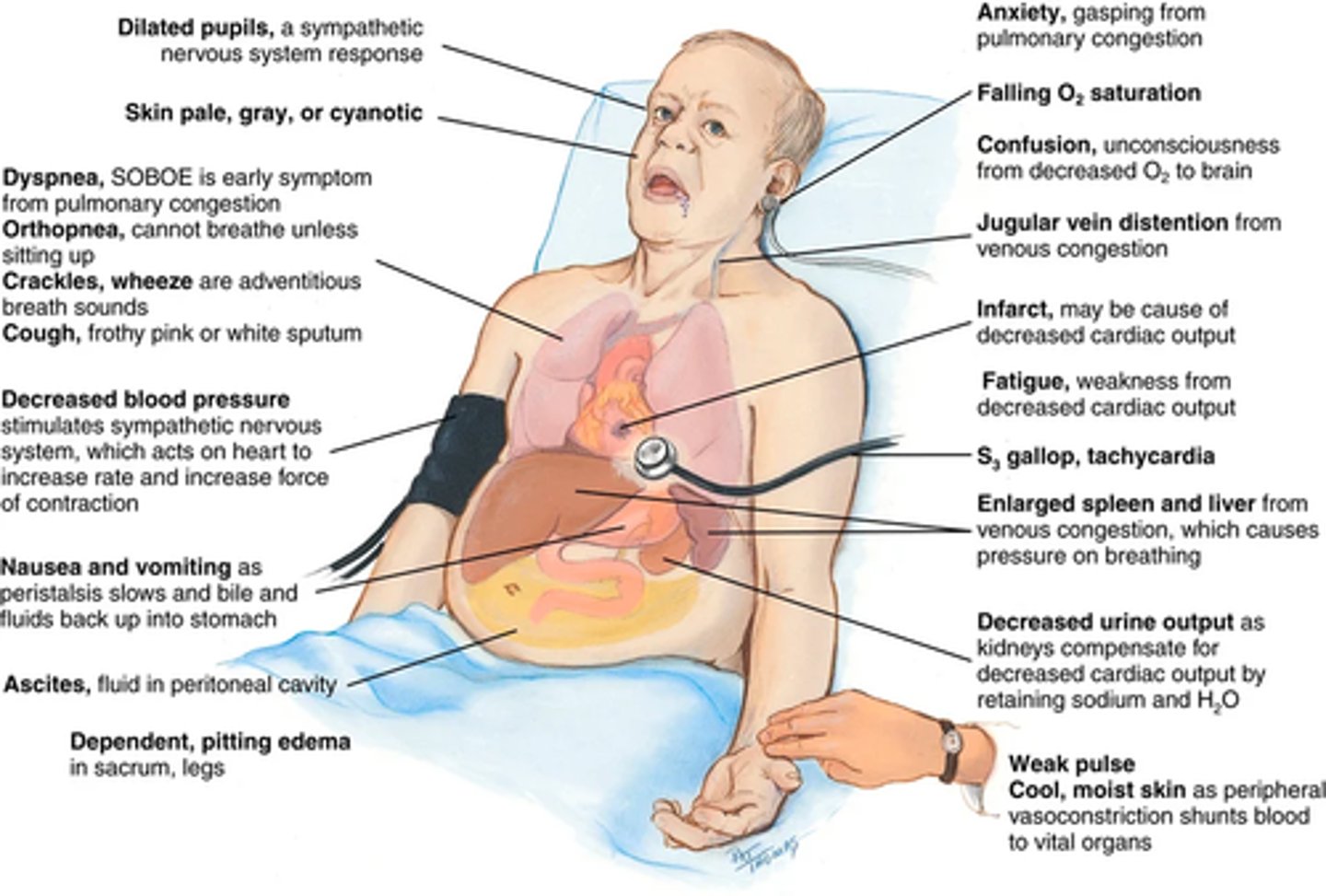 <p>Decreased cardiac output -> occurs when the heart fails as a pump and the circulation becomes backed up and congested.</p><p>Signs and symptoms come from:</p><p>(1) the heart's inability to pump enough blood to meet the metabolic demands of the body; (2) the kidney's compensatory mechanisms of abnormal retention of sodium and water to compensate for the decreased cardiac output.</p><p>(increased blood volume and venous return -> more congestion)</p><p>Onset: (1) acute, as following a myocardial infarction when the heart's contracting ability has been directly damaged</p><p>(2) chronic, as with hypertension, when the ventricles must pump against chronically increased pressure</p><p>Heart failure may involve systolic dysfunction -> heart cannot contract properly, resulting in a low ejection fraction (the stroke volume divided by the end-diastolic volume, normally 50% to 70%). AKA Heart failure with reduced ejection fraction</p><p>Diastolic dysfunction: failure of the heart to relax fully between heartbeats; here the heart muscle wall is stiff and does not fill properly; there is low cardiac output but a normal ejection fraction (also known as heart failure with preserved ejection fraction, or HFpEF).</p><p>(EF normal at rest, but may not raise properly with the stress of exercise)</p>
