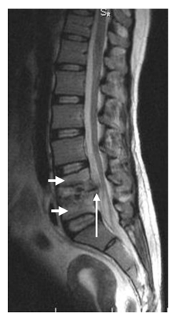 <p>A 59-year-old female is seen for back pain and lower limb weakness of two-months duration. Physical exam reveals sensory loss and weakness in both lower extremities. An MRI series of her vertebral column reveals the image to the right.</p><p>The rightward pointing arrows indicate two vertebral bodies with a defective intervertebral disk in-between. Which of the following most correctly indicates the vertebrae indicated?</p><p>A. L2 + L3</p><p>B. L3 + L4</p><p>C. L4 + L5</p><p>D. L5 + S1</p><p>E. S1 + S2</p>