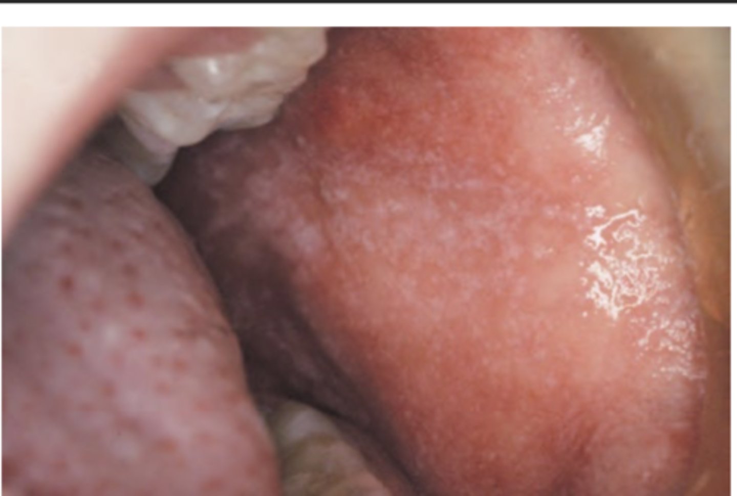 <p>Hint: Koplik spots</p>