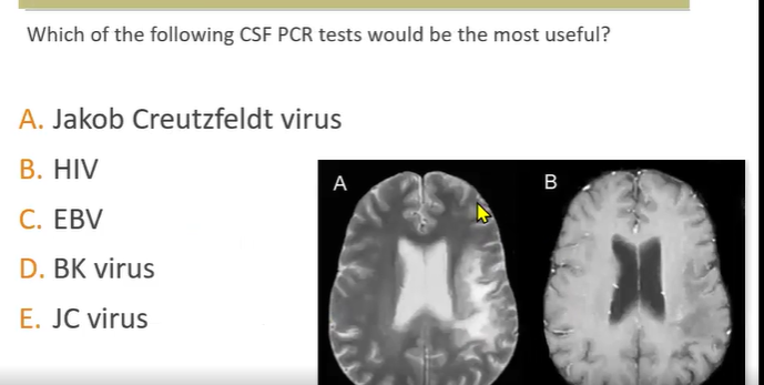 <p>JC virus in AIDS patients can cause <strong>Progressive Multifocal Leukoencephalopathy</strong><br>→ present with weakness and will have MRI findings of brain lesions with no atrophy</p>