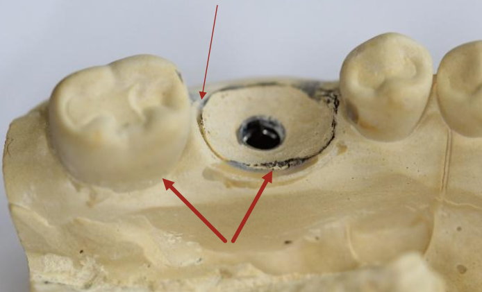 <p>Contouring should allow ______ soft tissue between implant restoration and adjacent tooth</p>