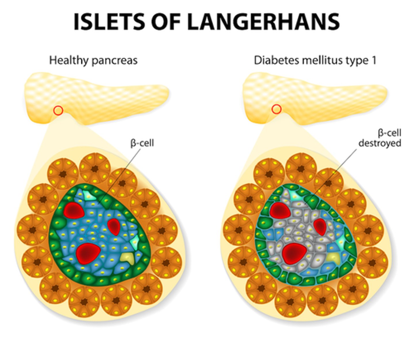 <p>- destruction of beta cells!!!</p><p>- dysfunction of glucose, fat, and protein metabolism</p><p>- immediate effects: disabled transport of glucose into cells</p>