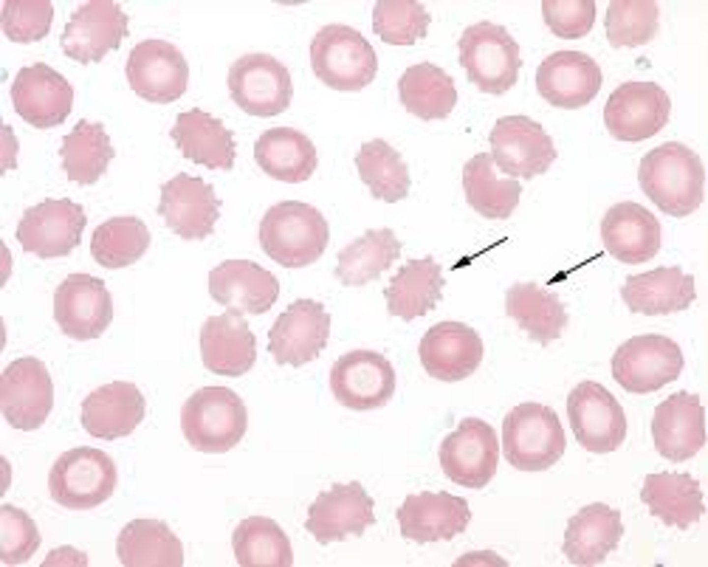 <p>- Uremia (kidney disease), pyruvate kinase deficiency</p>